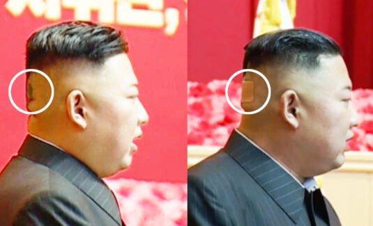 Csak találgatják, mi történt az észak-koreai diktátor fejével