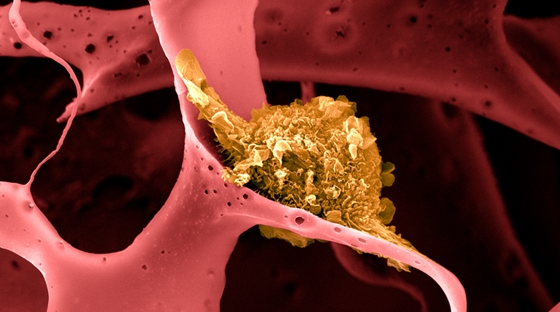 A daganatos sejtek 99%-át elpusztította egy új rákterápia